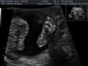 Tiny Foot